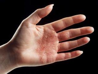 हाथों के इलाज पर त्वचा रोग
